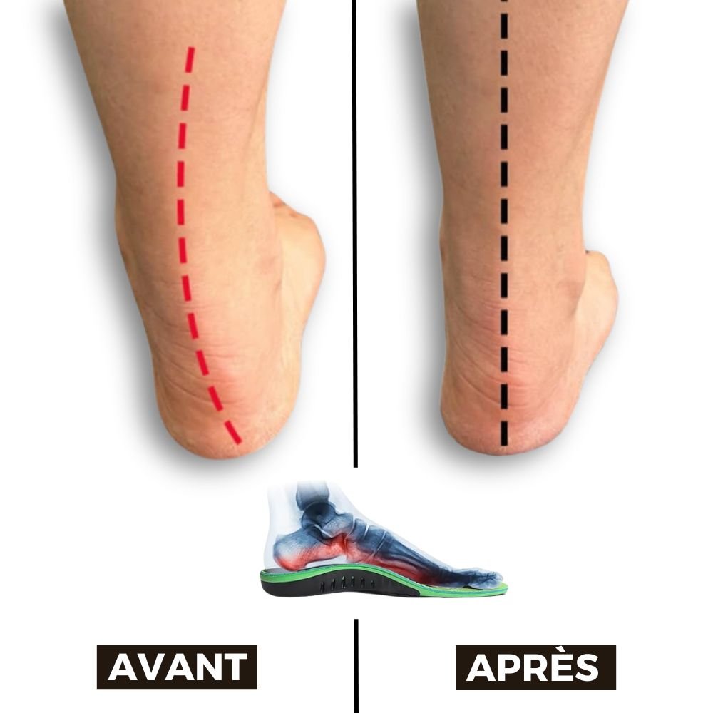 Semelles pour la Fasciite Plantaire-CHAUSSURES ORTHOPÉDIQUES-PARIS FEMME