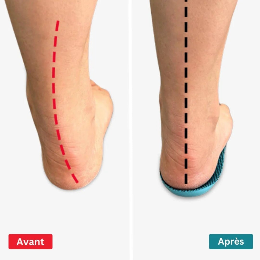 Semelles orthopédiques hallux valgus-CHAUSSURES ORTHOPÉDIQUES-PARIS FEMME