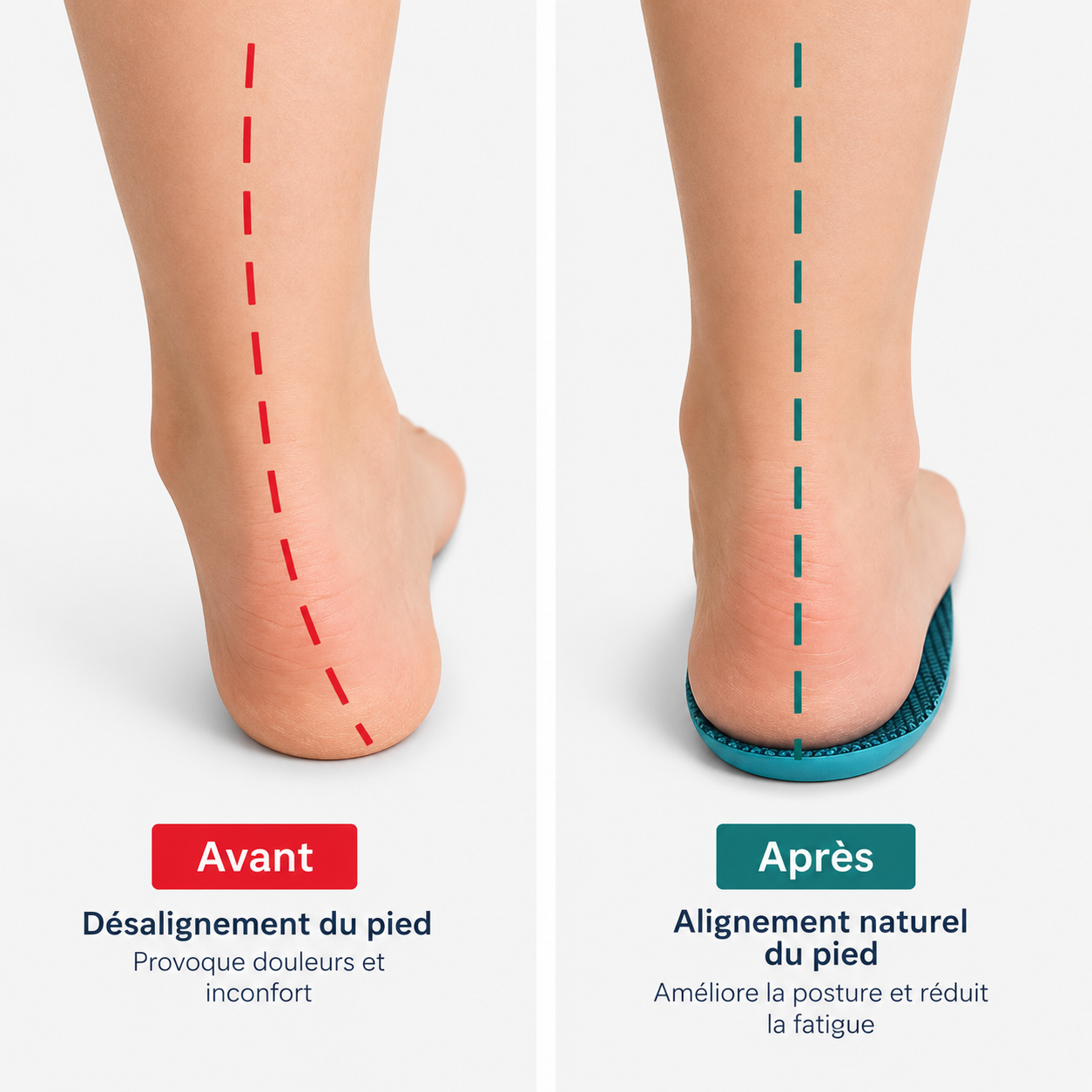 Semelles Orthopédiques Hallux Valgus Confort Correctif
